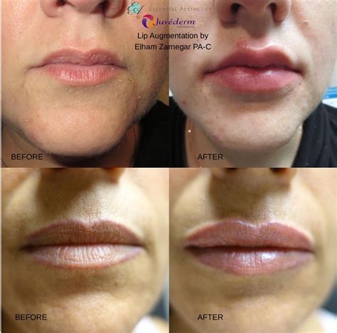Lip Line Magic: Enhancing the Natural Shape of your Lips